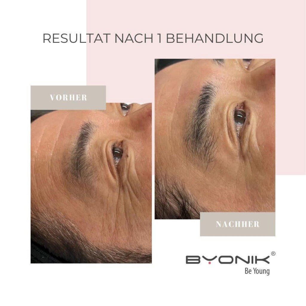 byonik resultat nach 1 behandlung