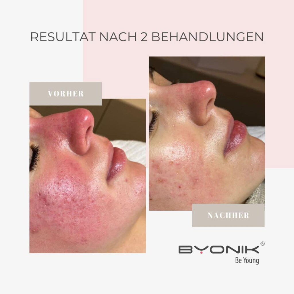 byonik resultat nach 2 behandlungen