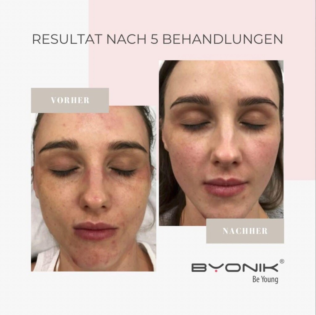 byonik resultat nach 5 behandlungen