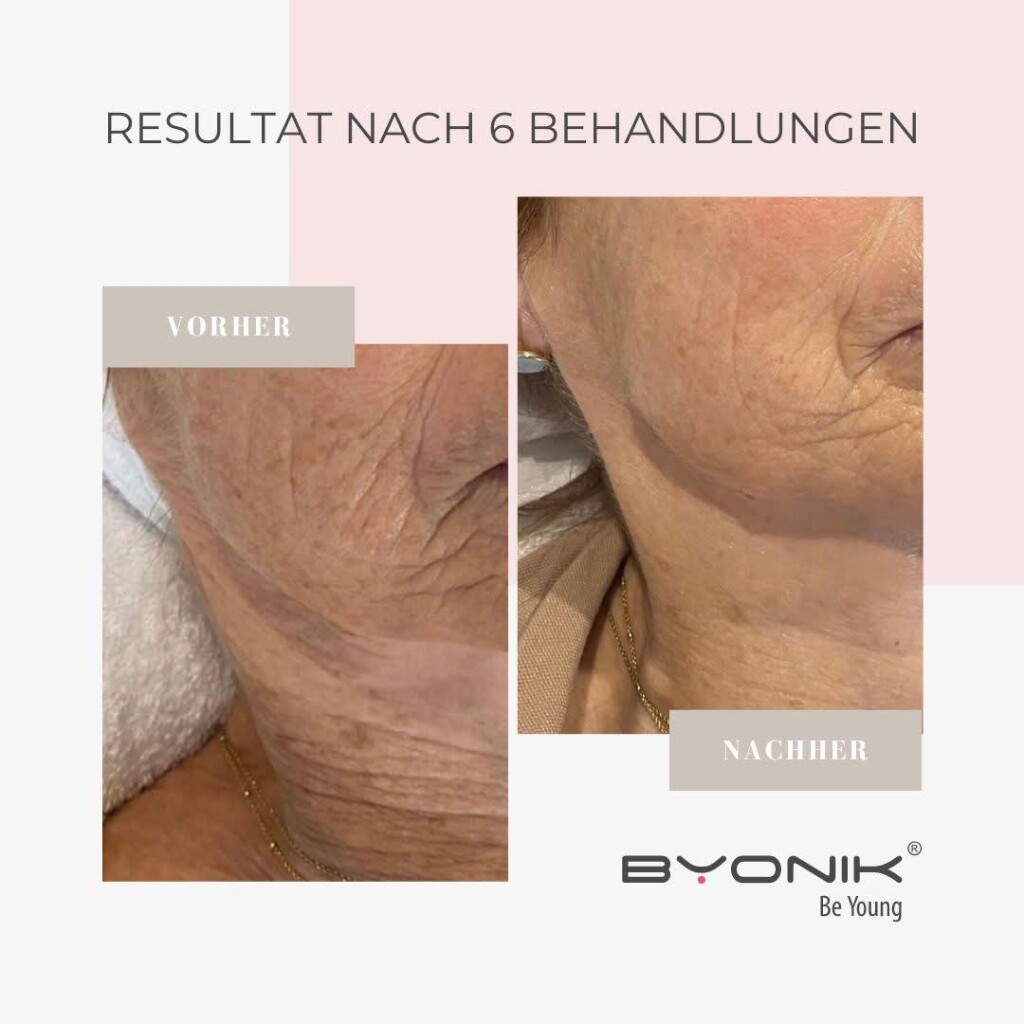 byonik resultat nach 6 behandlung