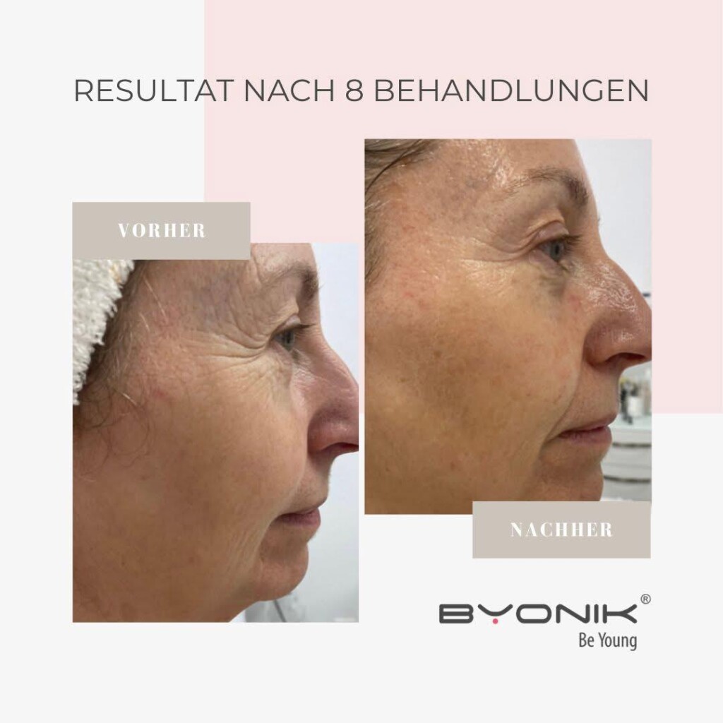 byonik resultat nach 8 behandlungen